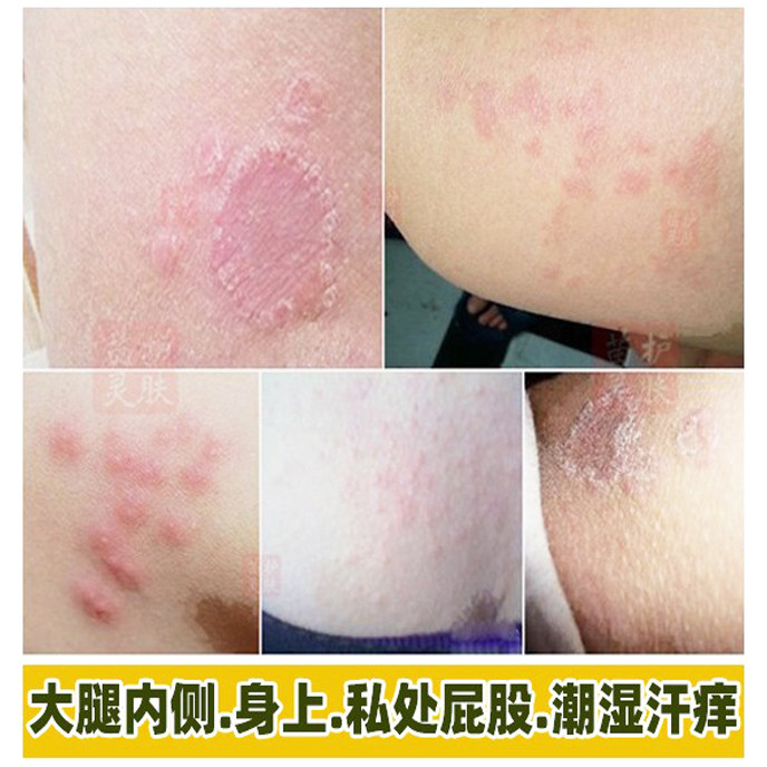御夫王冬季止痒抑菌乳膏