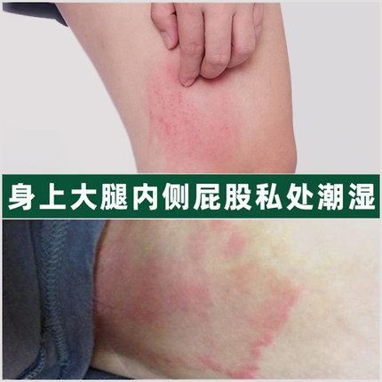 大腿内侧瘙痒止痒膏肛门股藓湿疹去外用根全身痒皮肤抑菌男士私处