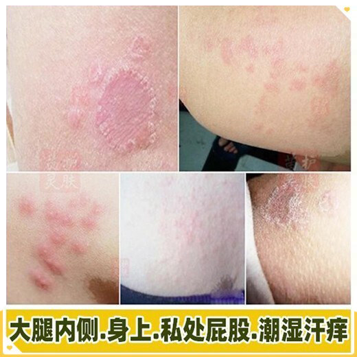 皮肤一热身上就痒洗澡干痒外用干燥起皮大腿内侧阴囊潮湿屁股疙瘩