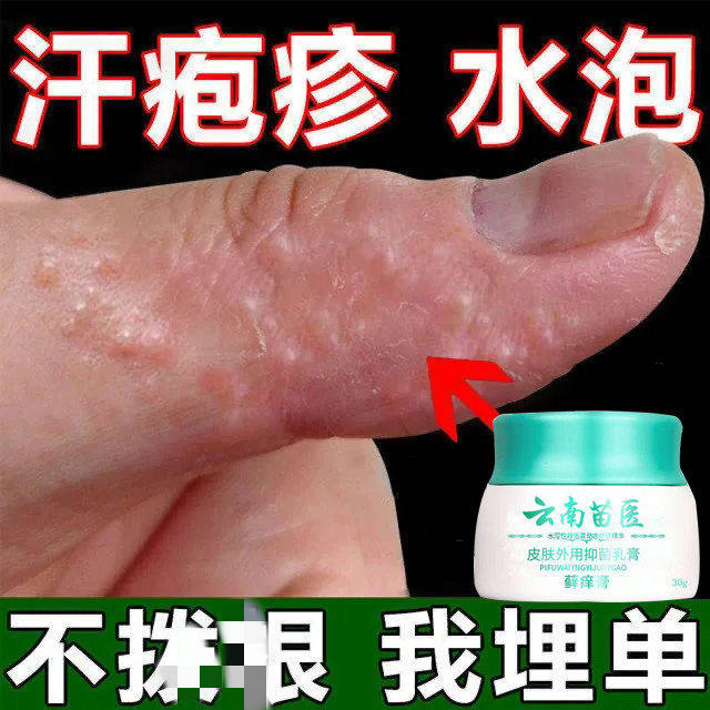 手藓手足藓鹅掌风湿汗疹疱止痒去皮疹干裂脱皮根真菌感染膏药