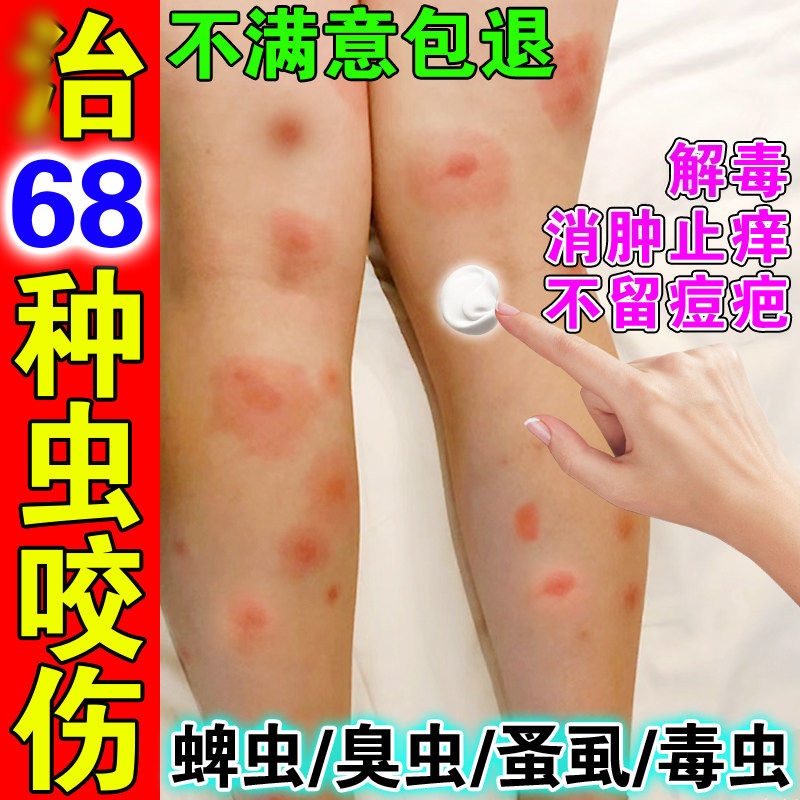 蚊子叮咬止痒膏臭虫咬伤药治毒虫蜱虫虱子跳蚤叮咬止痒消肿膏宝宝