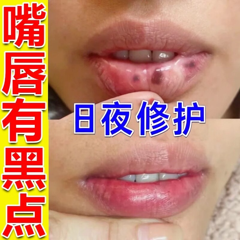 嘴唇黑点去除改善嘴唇黑斑黑色素沉淀淡化唇周暗沉唇纹专用润唇膏