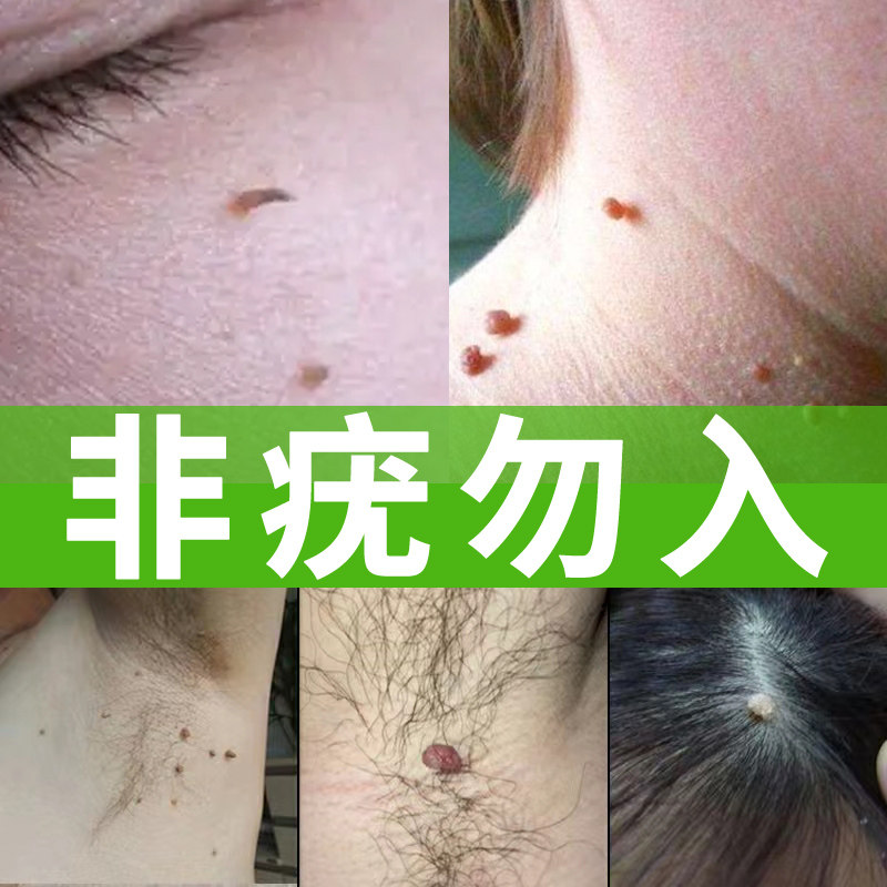 祛疣瘊子扁平疣去脖子上的小肉粒重组人干扰素α2a凝胶去疣非药膏