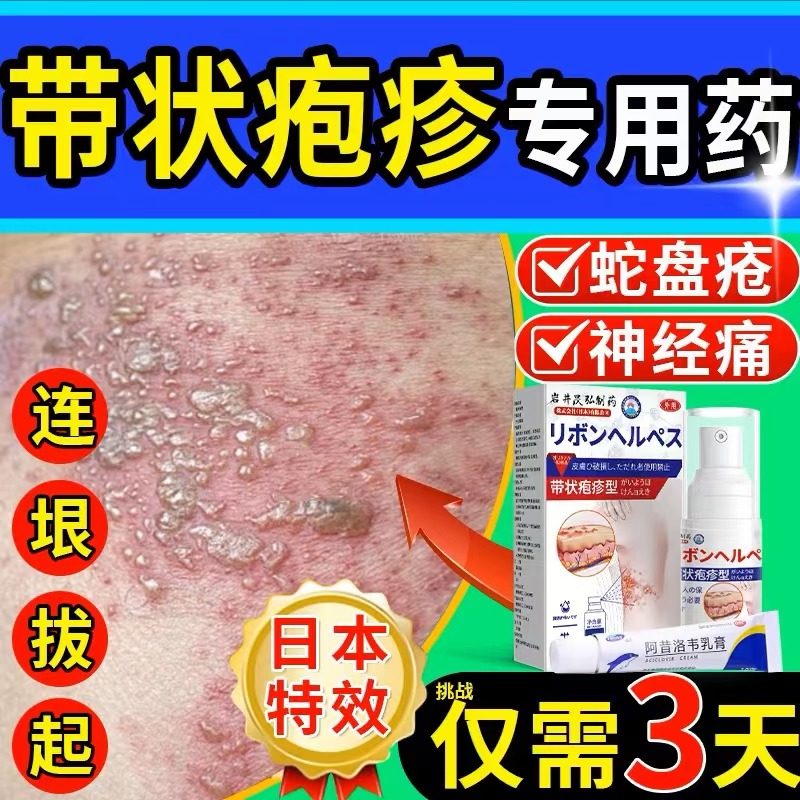 日本蛇盘疮带状包疹蛇缠