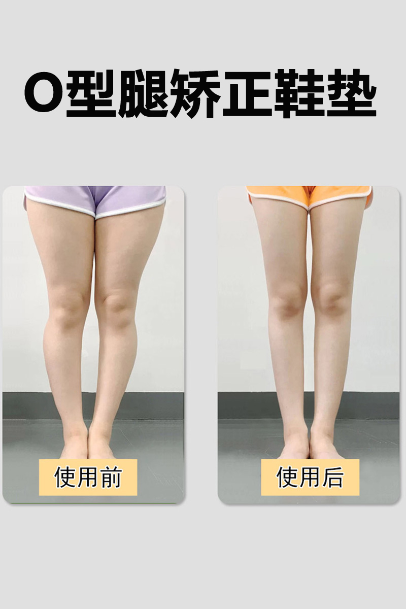 Xo型腿矫正鞋垫 价格 怎么样 图片 Xo型腿矫正鞋垫 价格 怎么样 图片