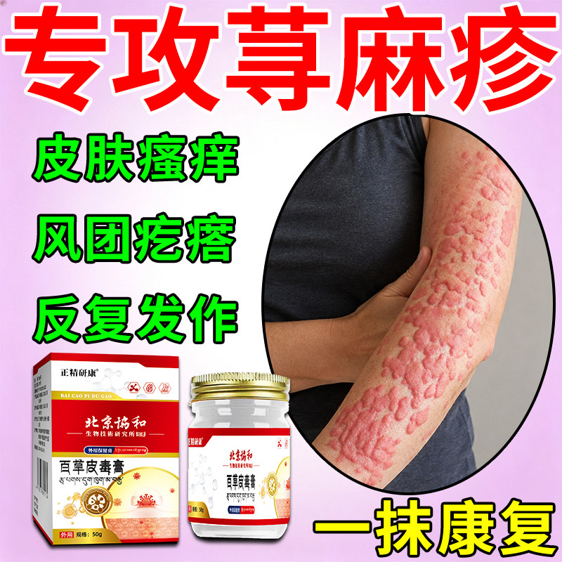 寻荨麻疹过敏止痒膏药胆碱性皮肤瘙痒风团疙瘩提高免疫力