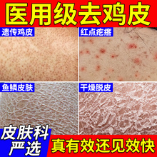 医用去鸡皮肤疙瘩毛囊角化角质症鱼鳞蛇纹手臂腿身体乳膏去除神器