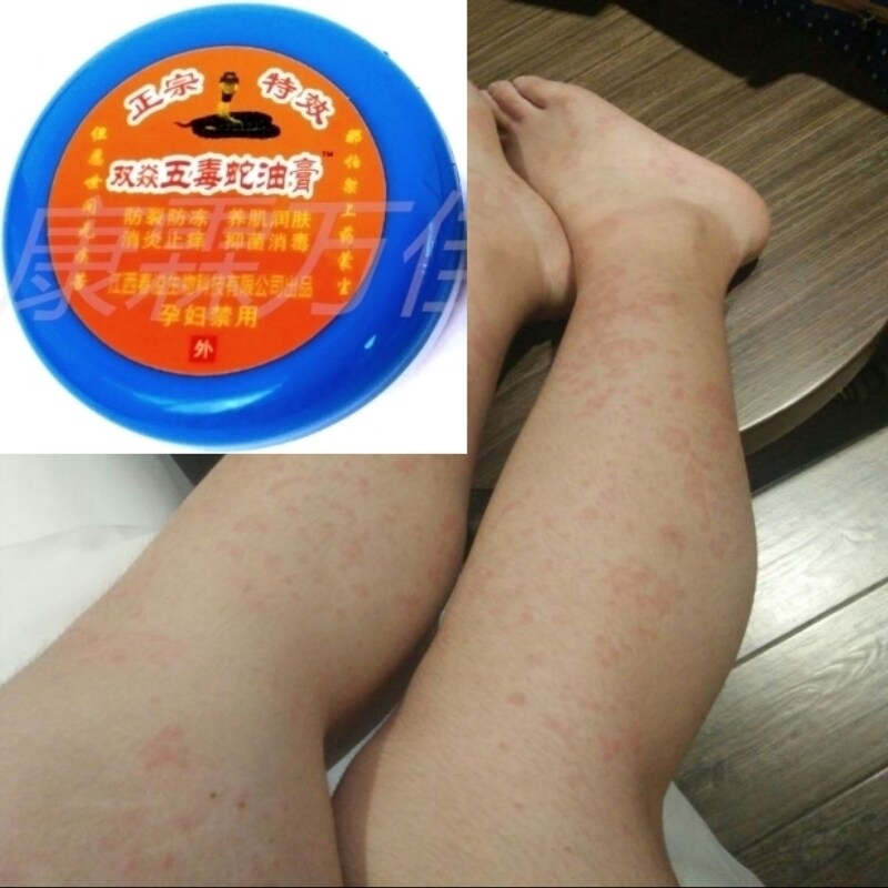 五毒蛇油膏  双焱 特价 脚痒手脚脱皮干裂蚊虫叮
