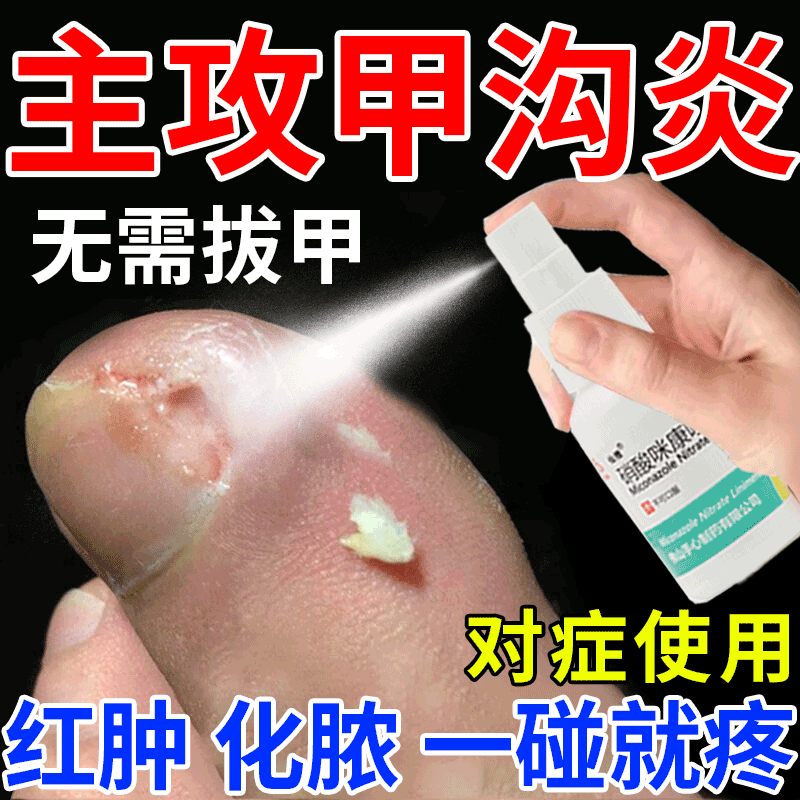 【仙雅】硝酸咪康唑搽剂2%*20ml*1瓶/盒甲沟炎治疗专用药脚趾甲往肉里长消炎喷雾喷剂