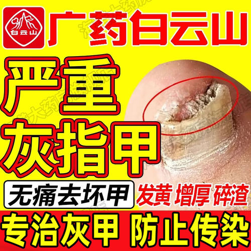 【白云山】硝酸益康唑乳膏1%*20g*1支/盒⭐【灰指甲效果NO*1】