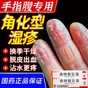 角化型湿疹手癣膏脱皮干裂真菌感染手掌粗糙增厚皮炎湿疹真菌感WM