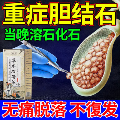 熊去氧胆酸片优思弗进口胆结石溶石化石胆囊息肉专用中草药贴金钱