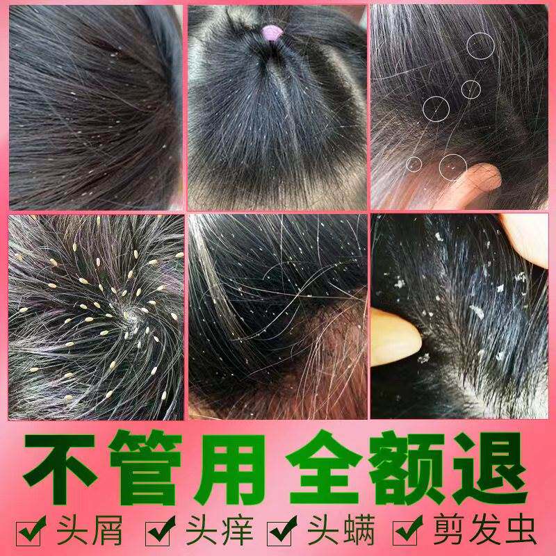 袪剪发虫洗发水女孩除螨虫卷发虫吃发虫专业去头屑止痒儿童洗发露