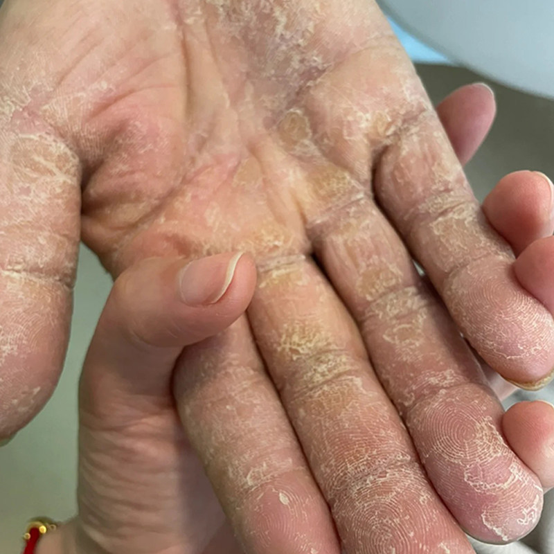 手脱皮修复霜季节性手掌手指头蜕皮开裂干裂维生素褪起皮掉皮爆