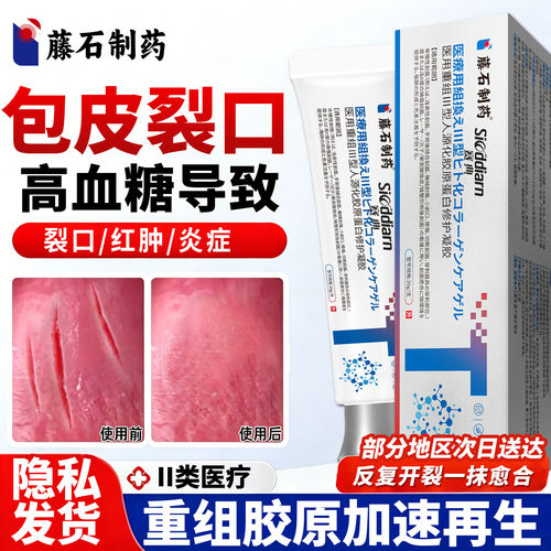 包皮开裂发炎专用龟头炎裂口阴茎疼痛红肿瘙痒真菌感染干裂破皮ZY
