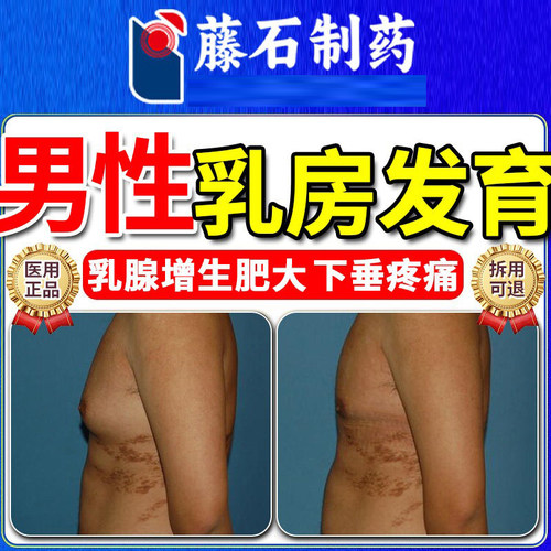 【医用】男性乳房发育增生肥大疼