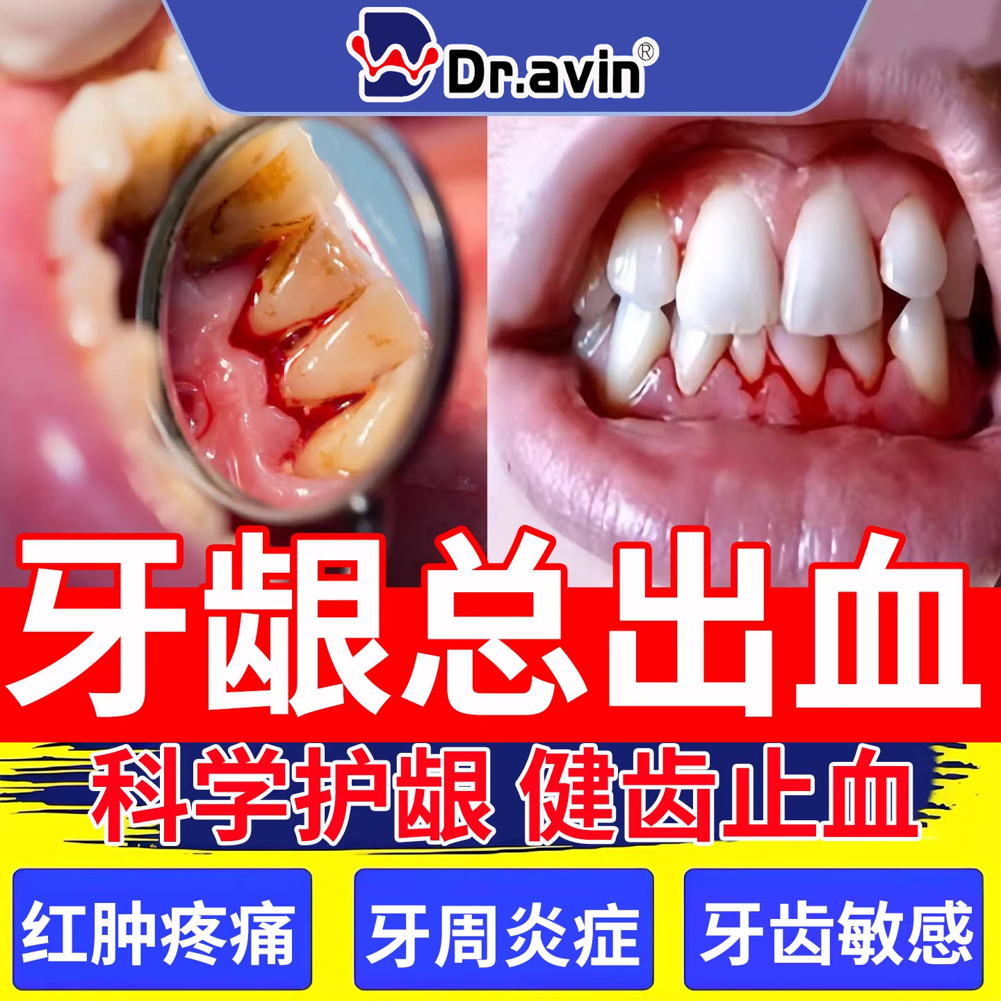 牙龈出血牙周炎牙齿止血口腔的口臭肿痛萎缩漱口水非牙膏YU