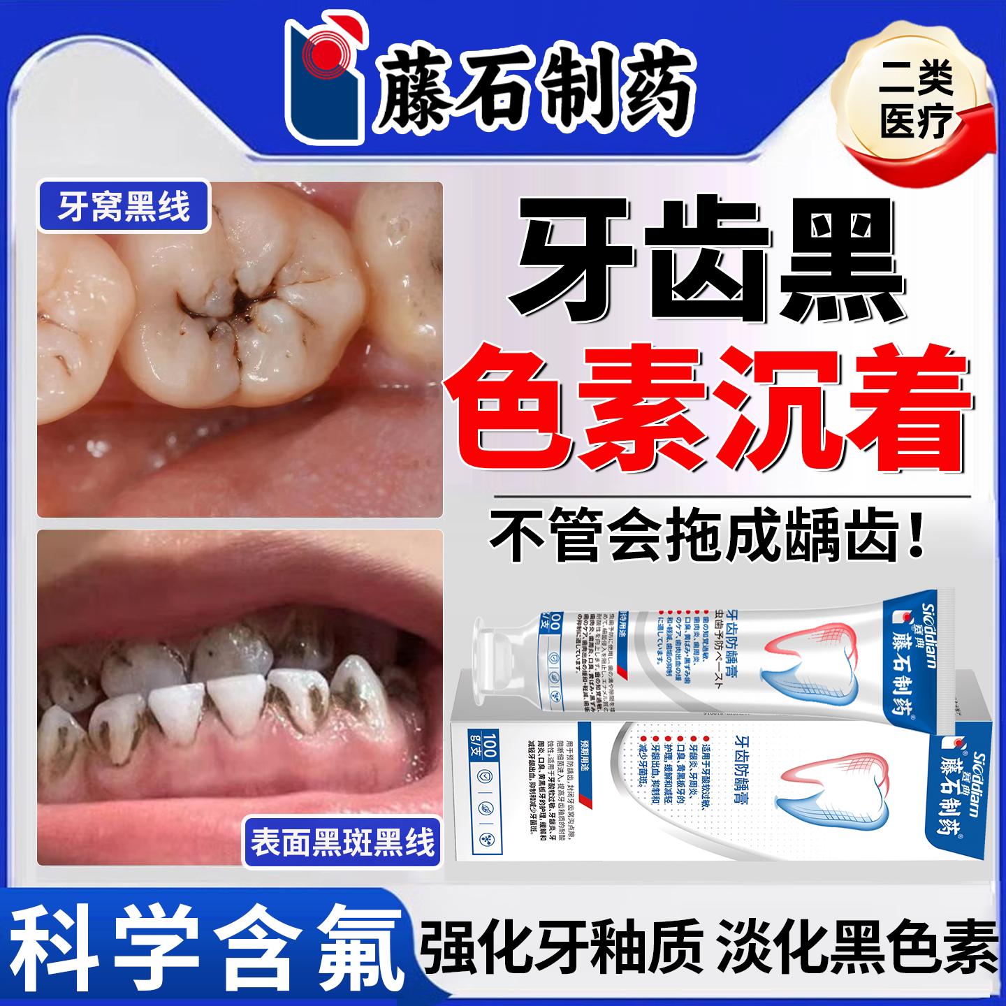 牙齿黑色素沉淀去除去黑线黑渍牙窝沟儿童牙菌斑黑牙搭专用牙膏ON