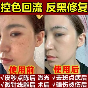 美容院专用祛斑后反黑修复控色霜淡化黑色素点斑后去黑印用的正品
