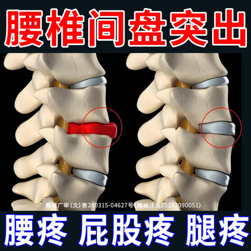 腰疼屁股疼腿疼腰突压迫神经贴膏