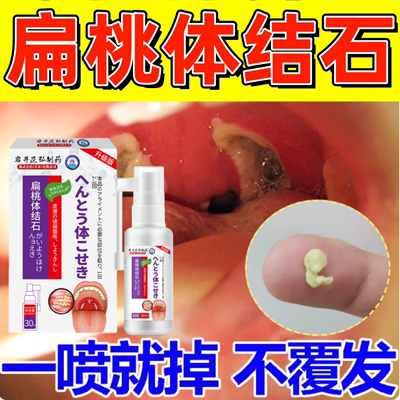 扁桃体结石去除工具喷剂漱口水清理隐窝冲洗器口腔异味口臭清洗器