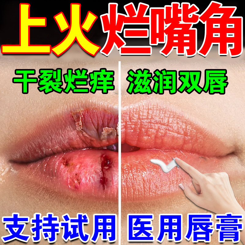嘴巴上火起泡烂嘴角膏药口角i炎唇膏儿童医用润修干裂复脱皮溃疡