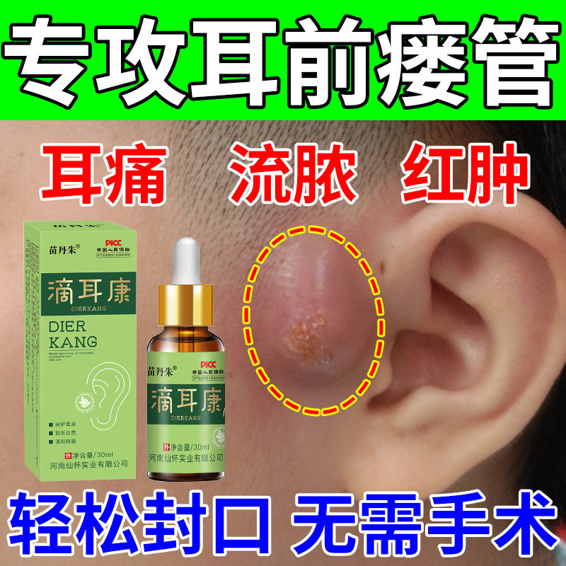 耳前瘘管药膏中耳炎耳仓发炎流脓红肿疼痛鼓包异味专用滴耳液神器