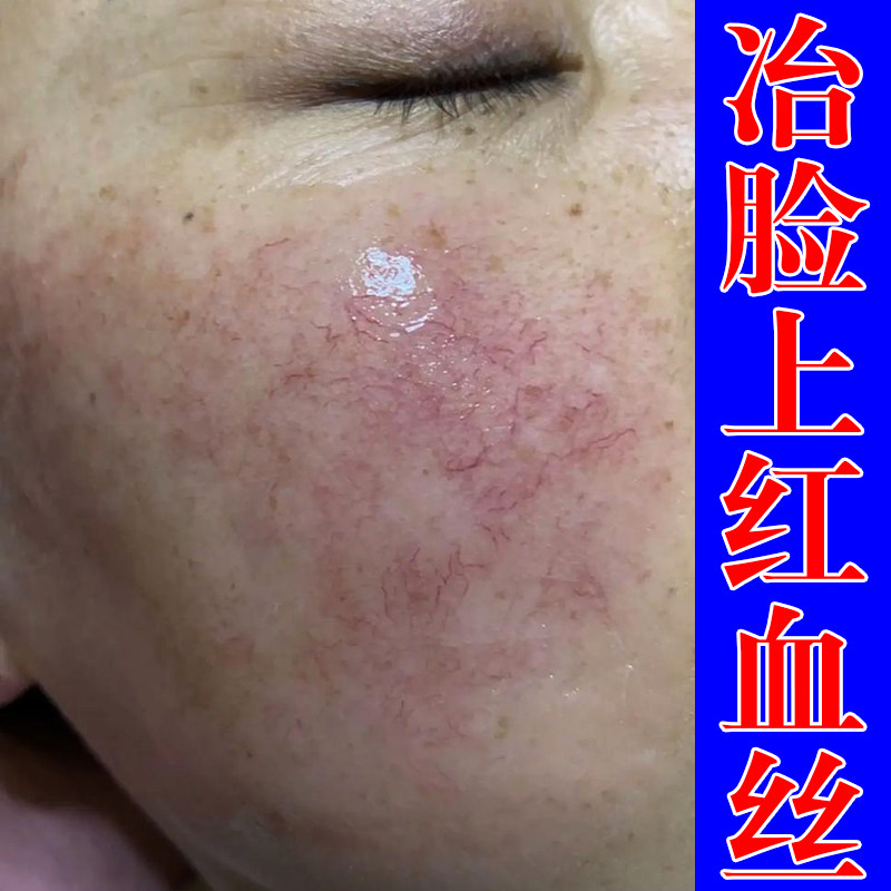 脸上红血丝严重草本修护乳膏脸上红血丝泛红角质层薄过敏长红血丝