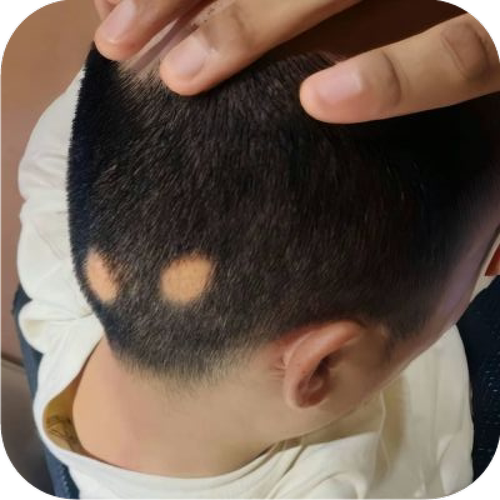 鬼剃头药斑秃治疗药地中海米诺地尔酊男女性防脱发生发育发精华液