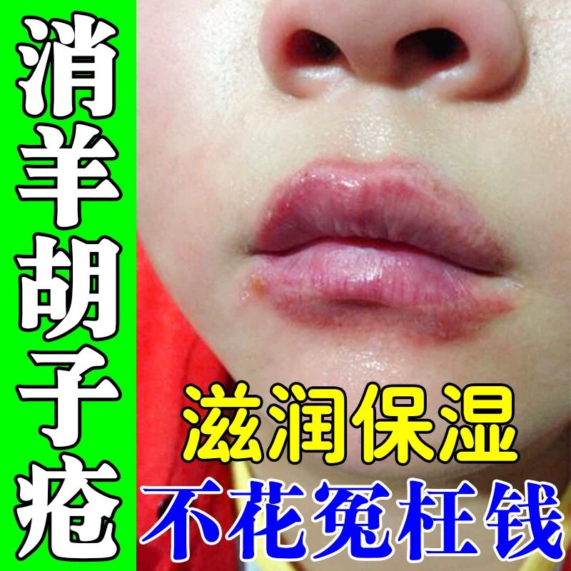 儿童唇炎专用唇膏嘴巴一圈红羊胡子疮膏药口周炎换季舔嘴唇干裂疼