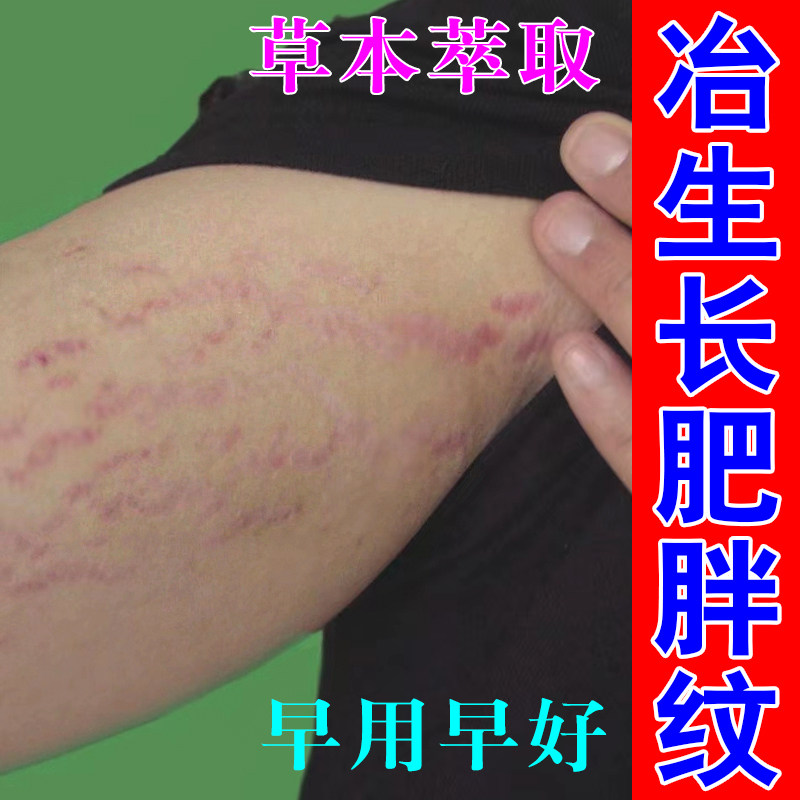 冶肥胖纹生长纹修复乳膏大腿学生腰腹上长肥胖纹男女通用草本软膏
