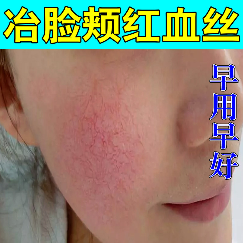 脸颊红血丝严重修脸上红血丝泛红角质层薄过敏高原红草本修护乳膏