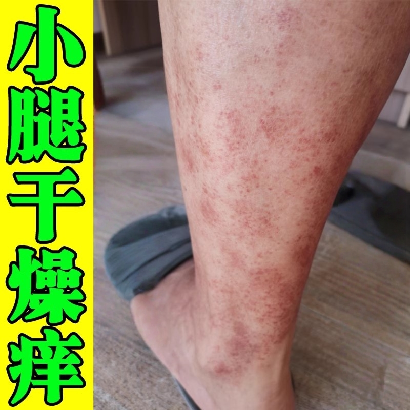 秋冬天小腿干痒治疗腿痒的药膏