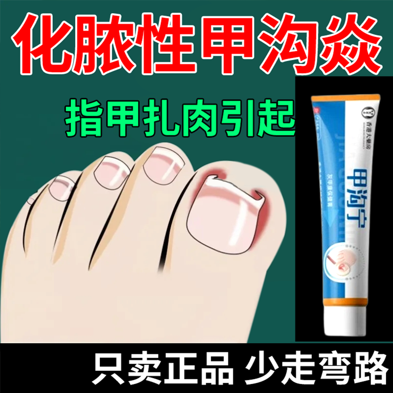 甲沟炎息肉去除用专非治疗嵌甲软化剂特脚指甲效往肉里长膏药神器