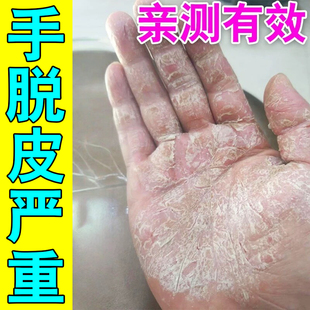 冶手掌心干裂脱皮蜕皮掉皮皮肤痒手指关节干燥痒专用草本修护乳膏