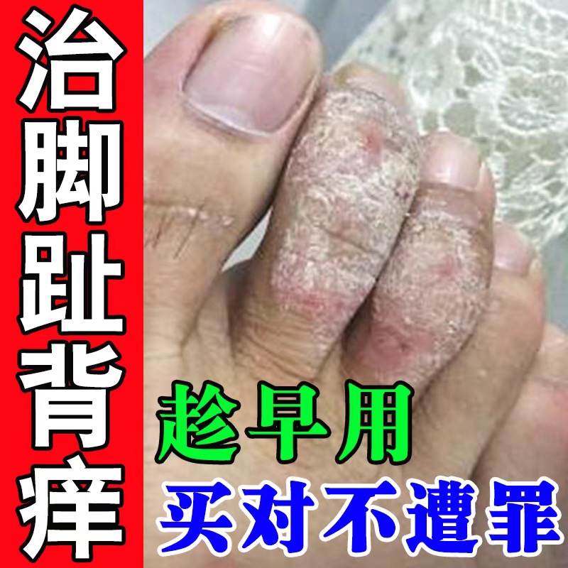 脚指背发痒脚趾头脚面脚上干燥起皮脱皮痒起皮屑长小红点专用乳膏