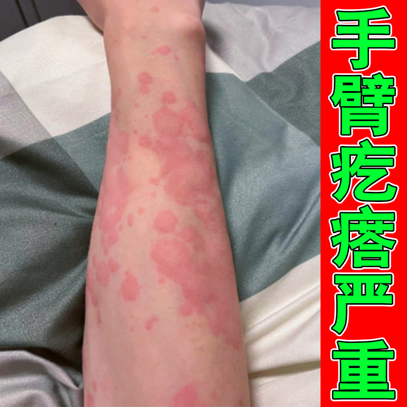 手臂长红疙瘩严重皮肤过敏发痒专用草本修护乳膏身上疙瘩红肿发痒