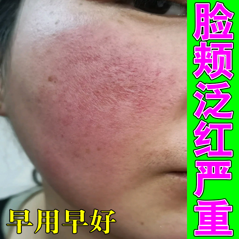 脸颊泛红严重脸上红血丝脸部泛红皮肤屏障受损专用草本修护乳膏