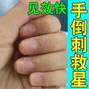 手指倒刺专用药膏营养油修复神器手指甲去死皮肉刺干裂脱皮修复霜