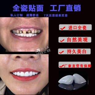 美牙全瓷牙贴片贴面私人订制美白牙齿蓝瓷琥珀瓷玻璃超薄全瓷牙冠