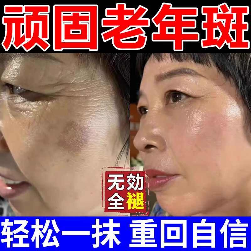 去斑祛黄褐斑雀斑膏官方正品专用药水一擦就掉药强力去除老年斑药