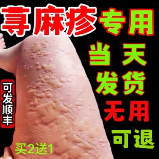 荨麻过敏止痒断专用膏去慢急性断过敏药皮肤瘙痒寻麻疹膏根皮肤