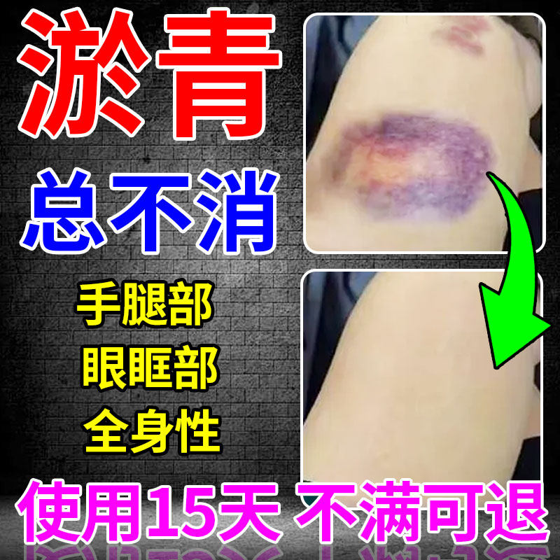 淤青快速否消除活血化瘀膏贴婴儿童宝宝去眼部消肿散撞伤发紫外用
