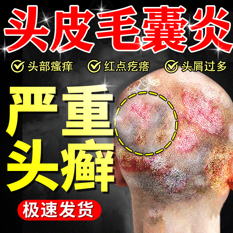 头痒有疙瘩毛囊炎非中药洗发水头皮癣非药膏真菌感染长痘痘头屑多