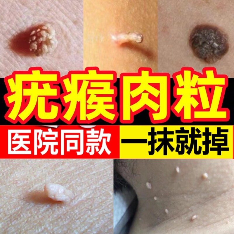 点猴子药水克优膏祛尤灵鸡尤清液鸭鸦胆子软膏去尤瘊小肉粒舒
