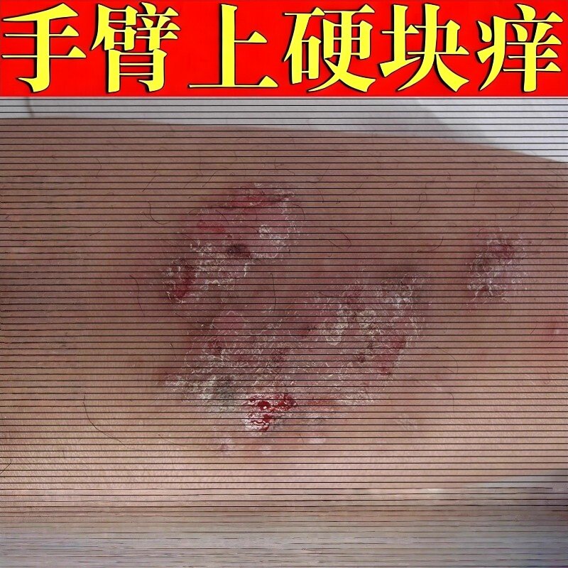 皮肤瘙痒红疹藓感染皮肤痒膏