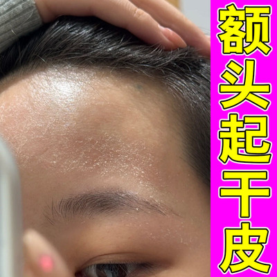 脸上干燥起皮泛红脸部红痒有碎屑掉皮屑滋润嘴边白屑