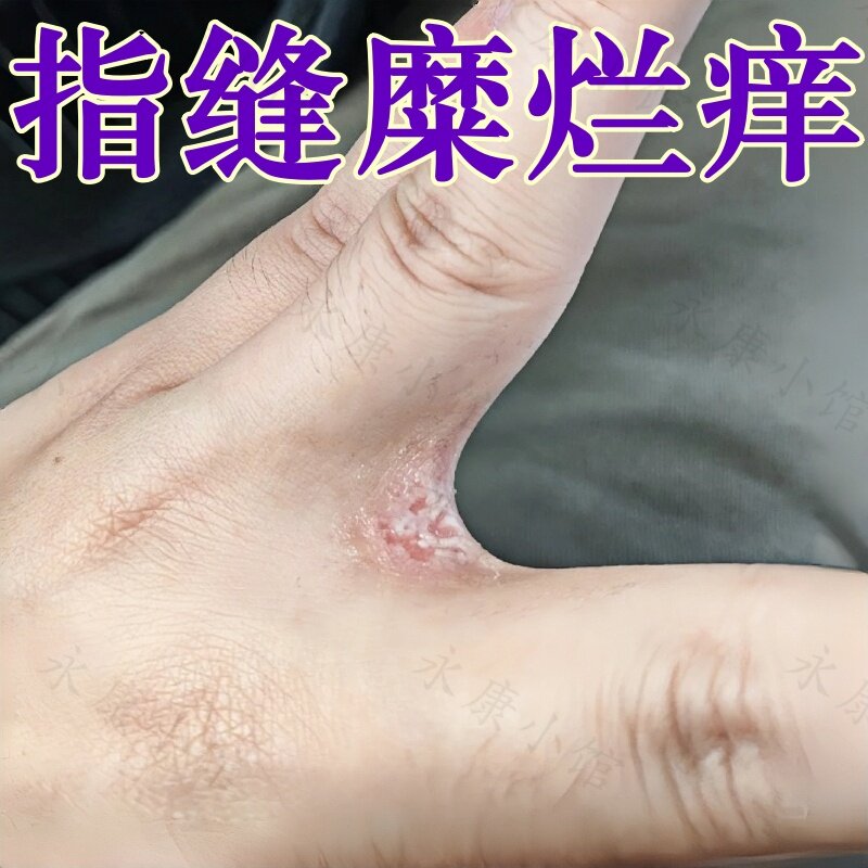 治手气脱皮烂手丫感染疼痛外用软膏皮肤干燥脱皮溃烂结痂痒修复药