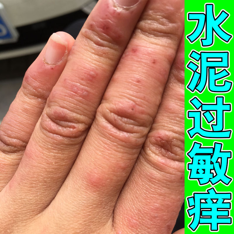 冶手上水泥过敏建筑专用手痒起小水泡皮肤干痒红肿修护乳膏