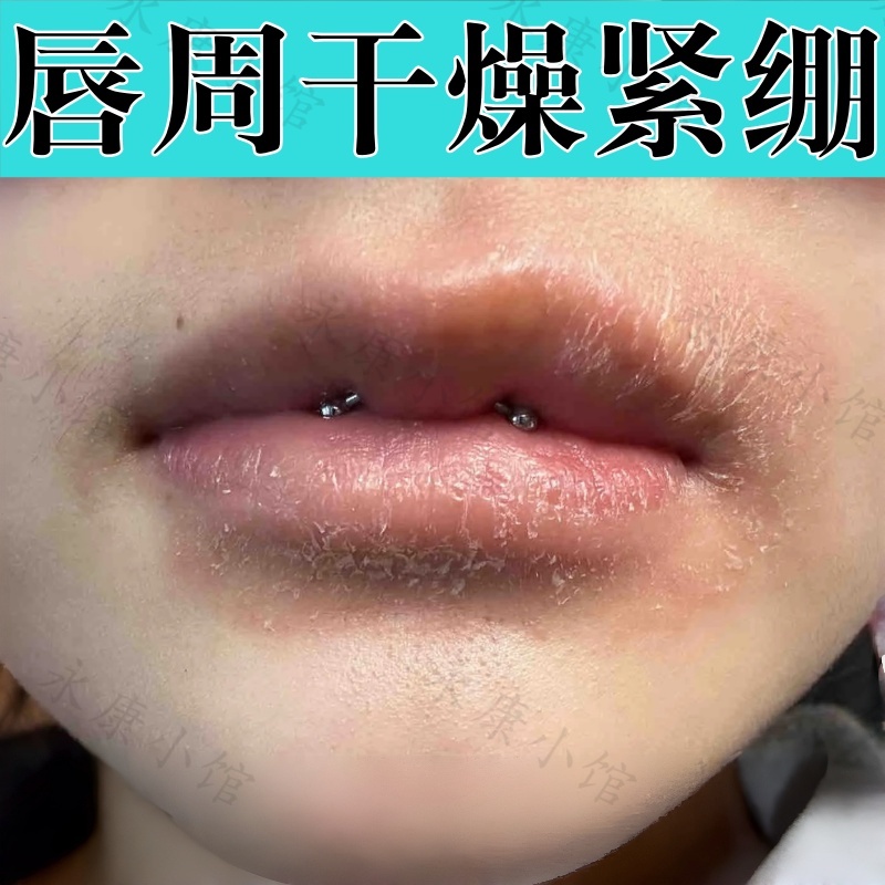 唇周干燥紧绷嘴巴干裂唇膏嘴周围起皮泛红光华性唇部炎舔嘴过敏膏